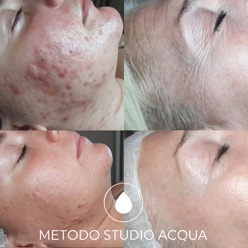 centro-acne-forli