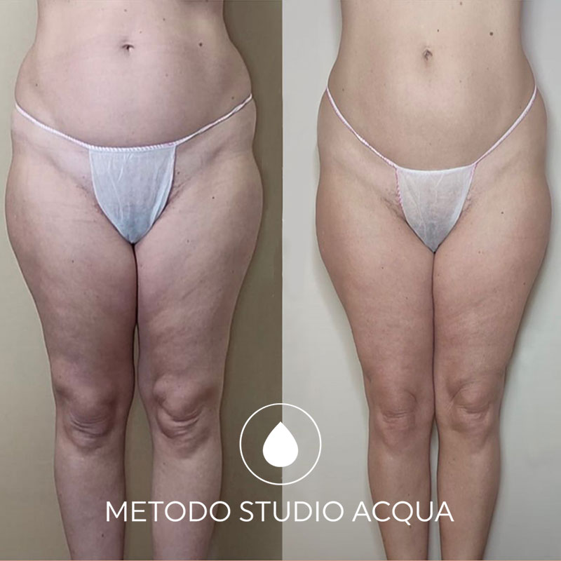 rimodellamento-corpo-forli